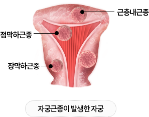 근층내근종 점막하근종 장막하근종 자궁근종이 발생한 자궁