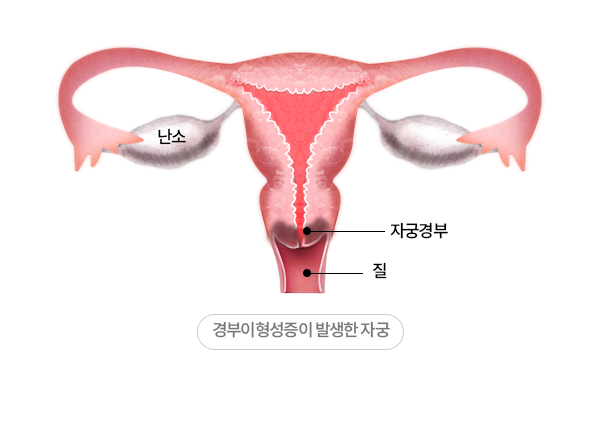 인천 자궁경부이형성증 한의원 암 위험을 낮추기 위해서는