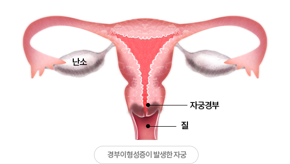 경부이형성증이 발생한 자궁