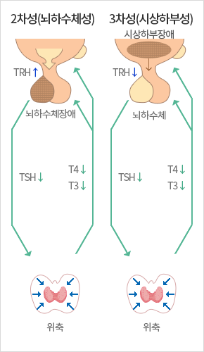 2차성(뇌하수체성) 3차성(시상하부성)