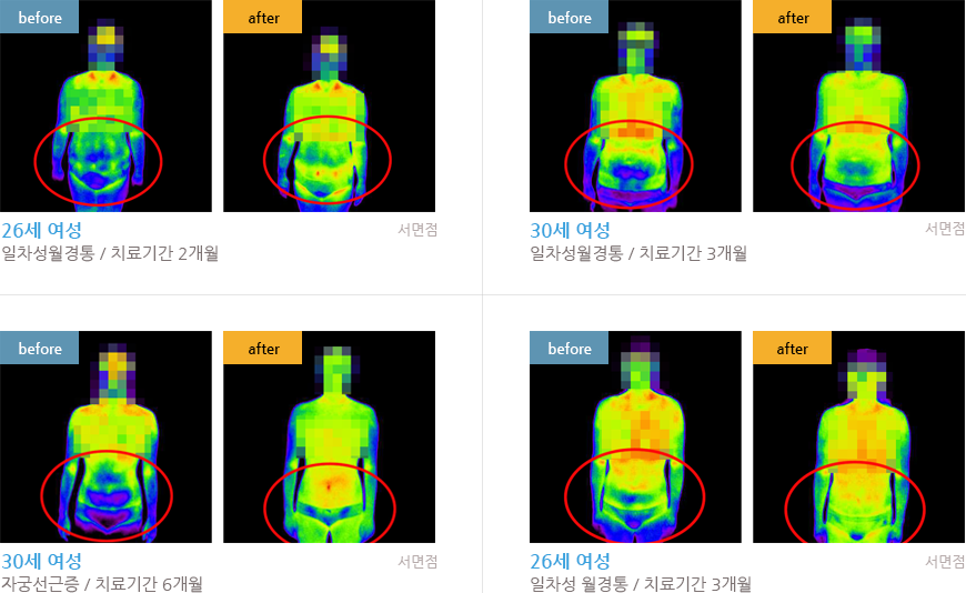 26세 여성 일차성월경통/치료기간 2개월 30세 여성 일차성월경통/치료기간 3개월 30세 여성 자궁선근증/치료기간 6개월 26세 여성 일차성 월경통/치료기간 3개월