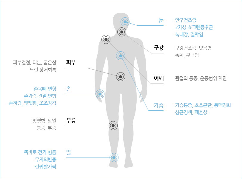 눈 안구건조증 2차성 쇼그렌증후군 녹내장, 결막염 구강 구강건조증, 잇몸병 충치, 구내염 어깨 관절의 통증, 운동범위 제한 가슴 가슴통증, 호흡곤란, 동맥경화 심근경색, 폐손상 피부 피부결절, 티눈, 굳은살 느린 상처회복 손 손목뼈 변형 손가락 관절 변형 손저림, 뻣뻣함, 조조강직 무릎 뻣뻣함, 발열 통증, 부종 발 똑바로 걷기 힘듬 무지외반증 갈퀴발가락