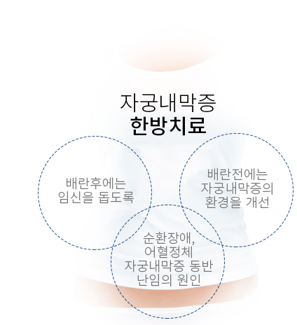 자궁내막증
	한방치료 - 배란후에는
	임신을 돕도록, 배란전에는
	자궁내막증의
	환경을 개선, 순환장애,
	어혈정체
	자궁내막증 동반
	난임의 원인
	